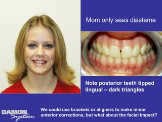 Mom only sees diastema




                     Note posterior teeth tipped
                     lingual – dark triangles


We could use brackets or aligners to make minor
anterior corrections, but what about the facial impact?
 