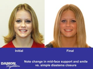 Initial                              Final


          Note change in mid-face support and smile
                 vs. simple diastema closure
 