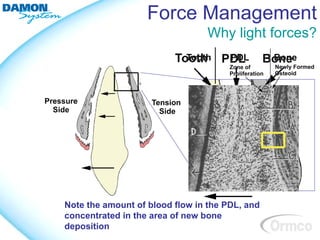 Force Management
                                Why light forces?




Note the amount of blood flow in the PDL, and
concentrated in the area of new bone
deposition
 