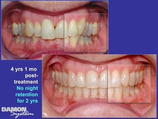 4 yrs 1 mo
       post-
 treatment
   No night
  retention
   for 2 yrs
 