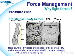 Force Management
                                  Why light forces?
Pressure Side

Traditional Heavy Forces




Note how blood vessels are crushed in the necrotic PDL
and how much bone must be eroded to cause movement
      with undermining resorption.
 
