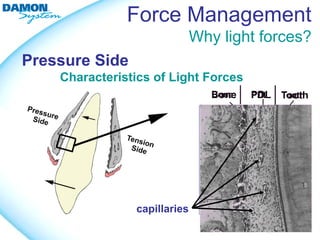 Force Management
                              Why light forces?
Pressure Side
    Characteristics of Light Forces




                capillaries
 