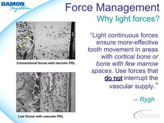 Force Management
                                           Why light forces?
                                         “Light continuous forces
                                            ensure more-effective
                                        tooth movement in areas
                                             with cortical bone or
Conventional forces with necrotic PDL
                                           bone with few marrow
                                          spaces. Use forces that
                                              do not interrupt the
                                                vascular supply.”

                                                         – Rygh

Low forces with vascular PDL
 