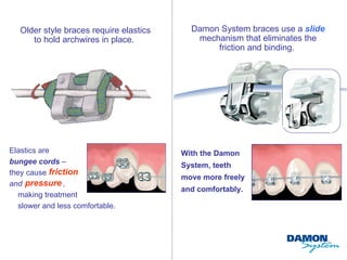 Older style braces require elastics     Damon System braces use a slide
      to hold archwires in place.           mechanism that eliminates the
                                                friction and binding.




Elastics are                      like   With the Damon
bungee cords –                           System, teeth
they cause friction
                                         move more freely
and pressure ,
                                         and comfortably.
   making treatment
   slower and less comfortable.
 