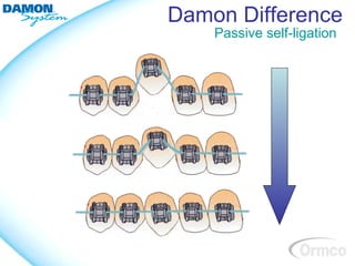 Damon Difference
    Passive self-ligation
 
