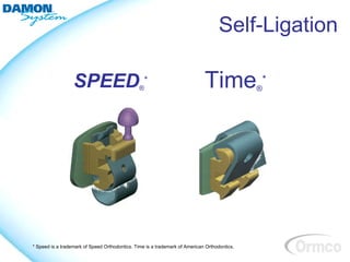 Self-Ligation

                  SPEED *                       ®                            Time *           ®




* Speed is a trademark of Speed Orthodontics. Time is a trademark of American Orthodontics.
 