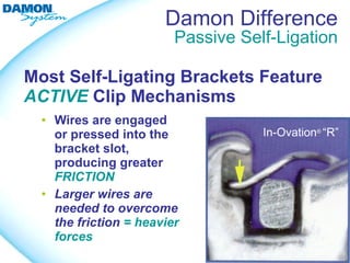 Damon Difference
                         Passive Self-Ligation

Most Self-Ligating Brackets Feature
ACTIVE Clip Mechanisms
  • Wires are engaged
    or pressed into the             In-Ovation® “R”
    bracket slot,
    producing greater
    FRICTION
  • Larger wires are
    needed to overcome
    the friction = heavier
    forces
 