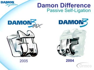 Damon Difference
         Passive Self-Ligation




2005              2004
 