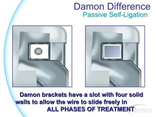 Damon Difference
                      Passive Self-Ligation




 Damon brackets have a slot with four solid
walls to allow the wire to slide freely in
            ALL PHASES OF TREATMENT
 