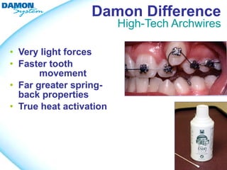 Damon Difference
                         High-Tech Archwires

• Very light forces
• Faster tooth
       movement
• Far greater spring-
  back properties
• True heat activation
 