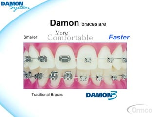 Damon braces are
                 More
Smaller      Comfortable         Faster




    Traditional Braces
 