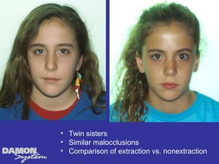 • Twin sisters
• Similar malocclusions
• Comparison of extraction vs. nonextraction
 