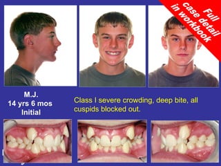 M.J.
14 yrs 6 mos   Class I severe crowding, deep bite, all
    Initial    cuspids blocked out.
 