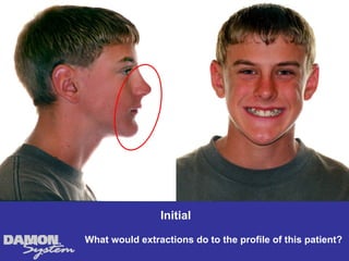 Initial

What would extractions do to the profile of this patient?
 