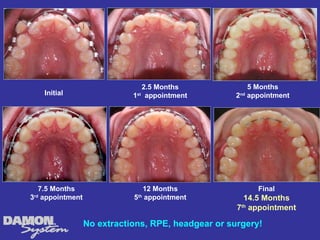 2.5 Months             5 Months
    Initial                  1 appointment
                              st                    2 appointment
                                                     nd




   7.5 Months                   12 Months                 Final
3rd appointment              5th appointment           14.5 Months
                                                     7th appointment

                  No extractions, RPE, headgear or surgery!
 