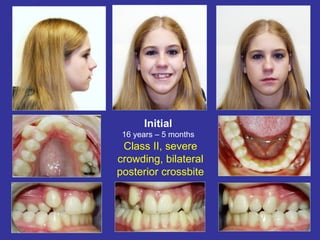 Initial
 16 years – 5 months
 Class II, severe
crowding, bilateral
posterior crossbite
 