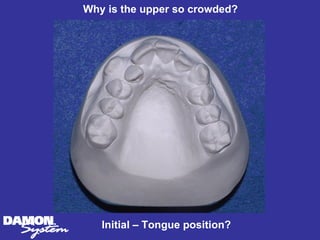 Why is the upper so crowded?




   Initial – Tongue position?
 