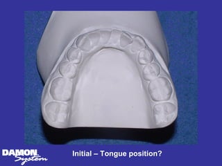 Initial – Tongue position?
 