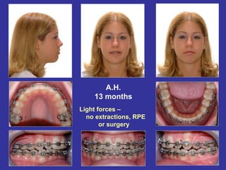 A.H.
    13 months
Light forces –
  no extractions, RPE
       or surgery
 