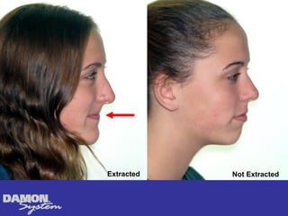 Extracted   Not Extracted
 