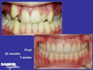 Final
22 months
         3 weeks
 