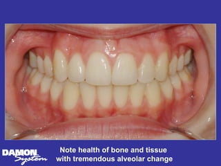 Note health of bone and tissue
with tremendous alveolar change
 