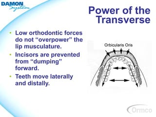 Power of the
                            Transverse
• Low orthodontic forces
  do not “overpower” the
  lip musculature.
• Incisors are prevented
  from “dumping”
  forward.
• Teeth move laterally
  and distally.
 