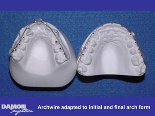 Archwire adapted to initial and final arch form
 