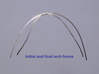 Initial and final arch forms
 