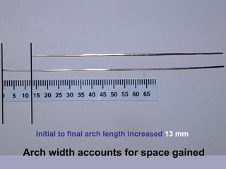 Initial to final arch length increased 13 mm

Arch width accounts for space gained
 
