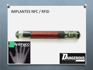 IMPLANTES NFC / RFID
 