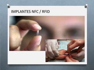 IMPLANTES NFC / RFID
 