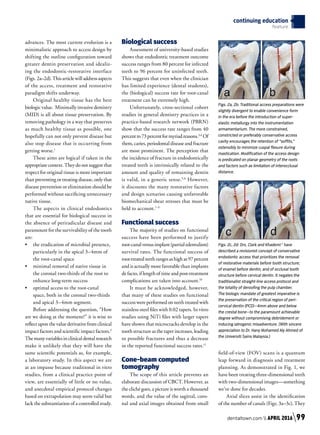 advances. The most current evolution is a
minimalistic approach to access design by
shifting the outline configuration toward
greater dentin preservation and idealiz-
ing the endodontic-restorative interface
(Figs. 2a–2d).Thisarticlewilladdressaspects
of the access, treatment and restorative
paradigm shifts underway.
Original healthy tissue has the best
biologic value. Minimally invasive dentistry
(MID) is all about tissue preservation. By
removing pathology in a way that preserves
as much healthy tissue as possible, one
hopefully can not only prevent disease but
also stop disease that is occurring from
getting worse.1
These aims are logical if taken in the
appropriate context. They do not suggest that
respect for original tissue is more important
than preventing or treating disease, only that
disease prevention or elimination should be
performed without sacrificing unnecessary
native tissue.
The aspects in clinical endodontics
that are essential for biological success in
the absence of periradicular disease and
paramount for the survivability of the tooth
are:
•	 the eradication of microbial presence,
particularly in the apical 3–4mm of
the root-canal space
•	 minimal removal of native tissue in
the coronal two-thirds of the root to
enhance long-term success
•	 optimal access to the root-canal
space, both in the coronal two-thirds
and apical 3–4mm segment.
Before addressing the question, “How
are we doing at the moment?” it is wise to
reflect upon the value derivative from clinical
impact factors and scientific impact factors.2
The many variables in clinical dental research
make it unlikely that they will have the
same scientific potentials as, for example,
a laboratory study. In this aspect we are
at an impasse because traditional in vitro
studies, from a clinical practice point of
view, are essentially of little or no value,
and anecdotal empirical protocol changes
based on extrapolation may seem valid but
lack the substantiation of a controlled study.
Biological success
Assessment of university-based studies
shows that endodontic treatment outcome
success ranges from 80 percent for infected
teeth to 96 percent for uninfected teeth.
This suggests that even when the clinician
has limited experience (dental students),
the (biological) success rate for root-canal
treatment can be extremely high.
Unfortunately, cross-sectional cohort
studies in general dentistry practices in a
practice-based research network (PBRN)
show that the success rate ranges from 40
percentto73percentformyriadreasons.3,4
Of
them, caries, periodontal disease and fracture
are most prominent. The perception that
the incidence of fracture in endodontically
treated teeth is intrinsically related to the
amount and quality of remaining dentin
is valid, in a generic sense.5,6
However,
it discounts the many restorative factors
and design scenarios causing unfavorable
biomechanical shear stresses that must be
held to account.7–9
Functional success
The majority of studies on functional
success have been performed to justify
root-canalversusimplant(partialedentulism)
survival rates. The functional success of
root-treatedteethrangesashighas97percent
and is actually more favorable than implants
de facto, if length of time and post-treatment
complications are taken into account.10
It must be acknowledged, however,
that many of these studies on functional
success were performed on teeth treated with
stainless-steel files with 0.02 tapers. In vitro
studies using NiTi files with larger tapers
have shown that microcracks develop in the
tooth structure as the taper increases, leading
to possible fractures and thus a decrease
in the reported functional success rates.11
Cone-beam computed
tomography
The scope of this article prevents an
elaborate discussion of CBCT. However, as
the cliché goes, a picture is worth a thousand
words, and the value of the sagittal, coro-
nal and axial images obtained from small
field-of-view (FOV) scans is a quantum
leap forward in diagnosis and treatment
planning. As demonstrated in Fig. 1, we
have been treating three-dimensional teeth
with two-dimensional images—something
we’ve done for decades.
Axial slices assist in the identification
of the number of canals (Figs. 3a–3c). They
continuing education
feature
Figs. 2a, 2b: Traditional access preparations were
slightly divergent to enable convenience form
in the era before the introduction of super-
elastic metallurgy into the instrumentation
armamentarium. The more constrained,
constricted or preferably conservative access
cavity encourages the retention of “soffits,”
ostensibly to minimize cuspal flexure during
mastication. Modification of the access design
is predicated on planar geometry of the roots
and factors such as limitation of interocclusal
distance.
Figs. 2c, 2d: Drs. Clark and Khademi  1
have
described a revisionist concept of conservative
endodontic access that prioritizes the removal
of restorative materials before tooth structure;
of enamel before dentin; and of occlusal tooth
structure before cervical dentin. It negates the
traditionalist straight-line access protocol and
the totality of deroofing the pulp chamber.
The biologic mandate of greatest imperative is
the preservation of the critical region of peri-
cervical dentin (PCD)—4mm above and below
the crestal bone—to the paramount achievable
degree without compromising debridement or
inducing iatrogenic misadventure. (With sincere
appreciation to Dr. Hany Mohamed Aly Ahmed of
the Universiti Sains Malaysia.)
Fig. 2a
Fig. 2c
Fig. 2b
Fig. 2d
dentaltown.com  APRIL 2016 99
 