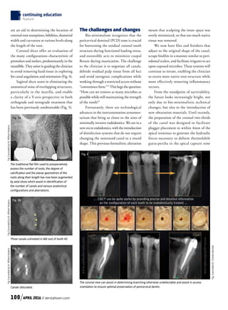 continuing education
feature
are an aid in determining the location of
external root resorptions, bifidities, diametral
width and curvature at various levels along
the length of the root.
Coronal slices offer an evaluation of
the many configurations characteristic of
premolars and molars, predominantly in the
mandible.Theyassistinguidingtheclinician
to avoid removing hard tissue in exploring
for canal angulation and orientation (Fig. 4).
Sagittal slices assist in eliminating the
anatomical noise of overlapping structures,
particularly in the maxilla, and enable
a clarity of a Y-axis perspective in both
orthograde and retrograde treatment that
has been previously unobtainable (Fig. 5).
The challenges and changes
Bio-minimalism recognizes that the
pericervical dentinal (PCD) zone is crucial
for buttressing the residual coronal tooth
structure during functional loading stress,
and ostensibly acts to minimize cuspal
flexure during mastication. The challenge
to the clinician is to negotiate all canals,
debride residual pulp tissue from all loci
and avoid iatrogenic complications while
working through a restricted access without
“convenience form.”12
This begs the question:
“How can we remove as many microbes as
possible while still maintaining the strength
of the tooth?”
Fortunately, there are technological
advances in the instrumentation armamen-
tarium that bring us closer to the aims of
minimally invasive endodontics. We are in a
newerainendodontics,withtheintroduction
of disinfection systems that do not require
changing the nonround canal to a round
shape. This previous formulistic alteration
meant that sculpting the inner space was
overly minimized, or that too much native
tissue was removed.
We now have files and finishers that
adjust to the original shape of the canal,
scrape biofilm in a manner similar to peri-
odontal scalers, and facilitate irrigants to act
upon exposed microbes. These systems will
continue to iterate, enabling the clinician
to retain more native root structure while
more effectively removing inflammatory
vectors.
From the standpoint of survivability,
the future looks increasingly bright, not
only due to bio-minimalistic technical
changes, but also to the introduction of
new obturation materials. Until recently,
the preparation of the coronal two-thirds
of the canal was designed to facilitate
plugger placement to within 4mm of the
apical terminus to generate the hydraulic
forces necessary to deform thermolabile
gutta-percha in the apical capture zone
Fig. 4
The coronal view can assist in determining branching otherwise undetectable and assist in access
orientation to ensure optimal preservation of pericervical dentin.
Fig. 3a
Fig. 3b
Fig. 3c
The traditional flat film used to preoperatively
assess the number of roots, the degree of
calcification and the planar geometries of the
roots along their length has now been augmented
by axial slices which assist in identification of
the number of canals and various anatomical
configurations and aberrations.
Three canals untreated in MB root of tooth #2.
Canals obturated.
Fig3providedbyDr.WilliamNuderaFig3providedbyDr.WilliamNuderaFig3providedbyDr.WilliamNudera
Fig.4providedDr.CharlesBoveda
100 APRIL 2016 // dentaltown.com
 