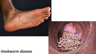 Hookworm disease
 
