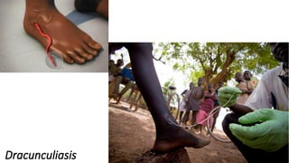 Dracunculiasis
 