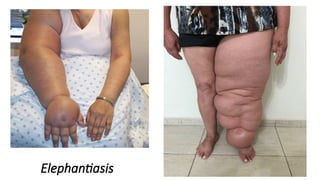 Elephantiasis
 