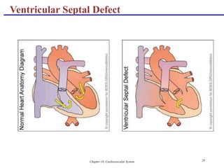 Chapter 18, Cardiovascular System 20
Ventricular Septal Defect
 
