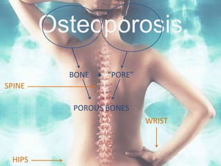 Osteoporosis BONE “PORE” + SPINE POROUS BONES WRIST HIPS 