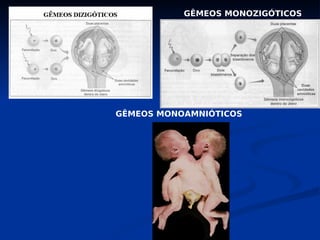 GÊMEOS MONOZIGÓTICOS
GÊMEOS MONOAMNIÓTICOS
 