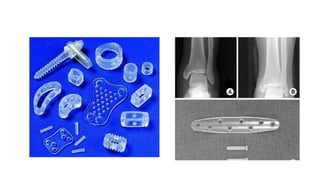 Bioabsorbable implants | PPTX