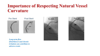 Importance of Respecting Natural Vessel
Curvature
91°
88
Long-term flow
disturbances and chronic
irritation can contribute to
adverse events
Pre BVS Post BVS
 