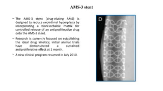 AMS-3 stent
• The AMS-3 stent (drug-eluting AMS) is
designed to reduce neointimal hyperplasia by
incorporating a bioresorbable matrix for
controlled release of an antiproliferative drug
onto the AMS-2 stent.
• Research is currently focused on establishing
the ideal drug kinetics; initial animal trials
have demonstrated a sustained
antiproliferative effect at 1 month.
• A new clinical program resumed in July 2010.
 