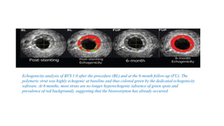 Echogenicity analysis of BVS 1.0 after the procedure (BL) and at the 6-month follow-up (FU). The
polymeric strut was highly echogenic at baseline and thus colored green by the dedicated echogenicity
software. At 6 months, most struts are no longer hyperechogenic (absence of green spots and
prevalence of red background), suggesting that the bioresorption has already occurred
 