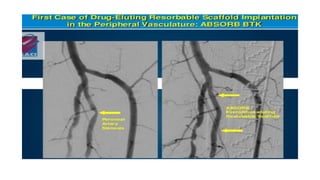 BIOABSORBABLE VASCULAR SCAFFOLD AND ITS APPLICATIONOLD.pptx
