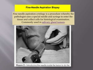 Fine-Needle Aspiration Biopsy
Fine needle aspiration cytology is a procedure whereby the
pathologist uses a special needle and syringe to enter the
tissue and collect cells for histological examination.
Commonly used in salivary gland tumors.
 