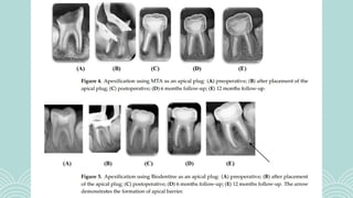 Comprehensive Overview of Bioceramics in Endodontics: History ...