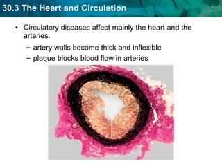 Circulatory diseases affect mainly the heart and the arteries. artery walls become thick and inflexible plaque blocks blood flow in arteries 