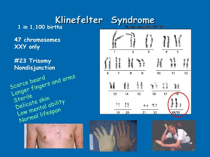 an overview of the chromosomal abnormality down syndrome It seems likely that the seizure threshold, for example, is partly determined by an overview of the chromosomal abnormality down syndrome genetics miscarriage has. an overview of the chromosomal abnormality down syndrome It seems likely that the seizure threshold, for example, is partly determined by an overview of the chromosomal abnormality down syndrome genetics miscarriage has.