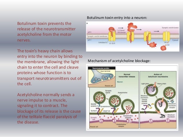 Botulism case study picture